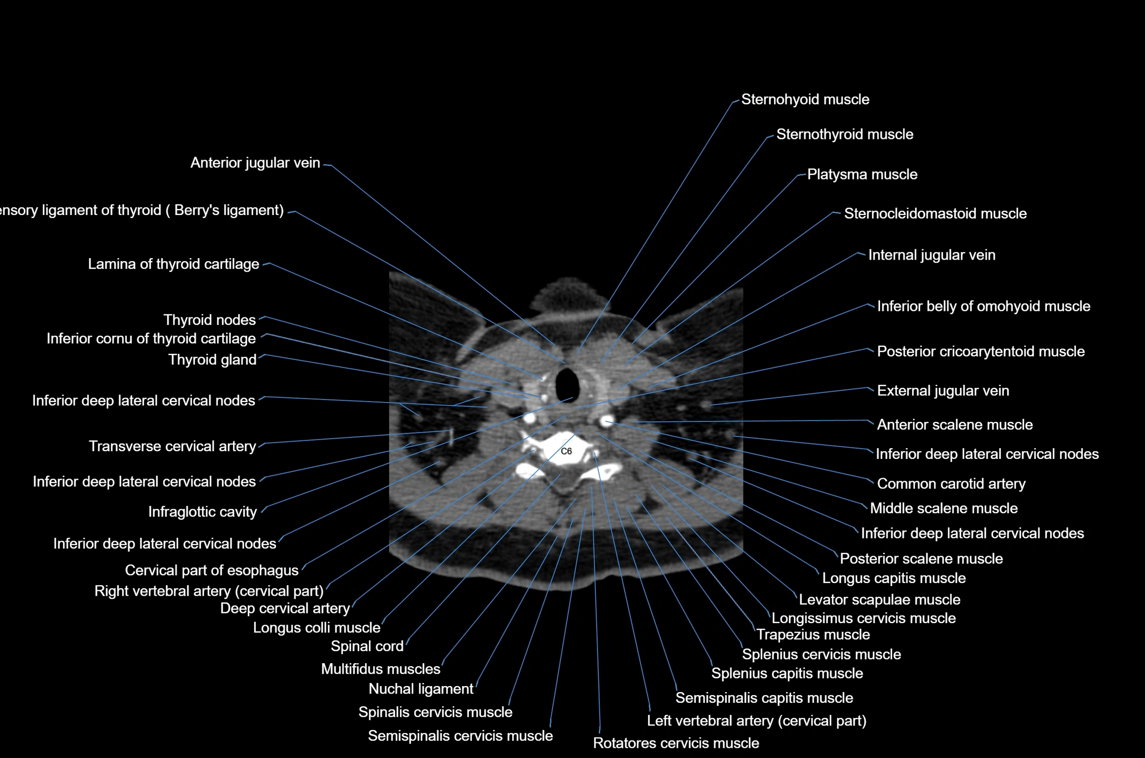 CT Neck axial cross sectional anatomy radiology image-img-00001-00046.webp